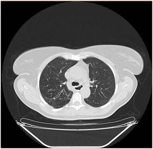 Chest computed tomography showing bronchiectasis.