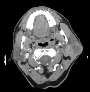 parotid gland tumor mass unilateral benign tumors synchronous lobes involving glndula partida malignant