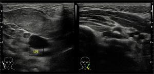 Músculo esternocleidomastóideo (ECM) direito é volumoso se comparado com o esquerdo com perda de estriações normais. A lesão é anterior à artéria carótida comum direita e veia jugular interna direita (V, veia jugular interna; LN, linfonodo).