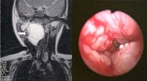 Imagem de ressonância magnética mostra lesão em espaço retrofaríngeo à direita (seta). Imagem endoscópica da via aérea superior (direitada foto).