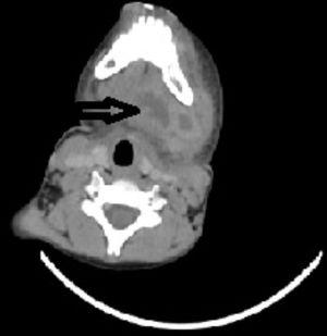 Tomografia computadorizada do paciente (seta preta mostra o abscesso submandibular).