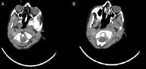 Em A, observa‐se o corpo de C1 na tomografia computadorizada; B, tomografia computadorizada demonstra a subluxação rotacional atlantoaxial.