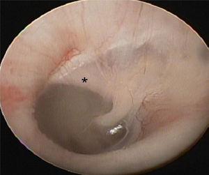 Otoendoscopia mostra a fixação congênita do martelo (asterisco) entre o colo do martelo e o ânulo ósseo posterior.