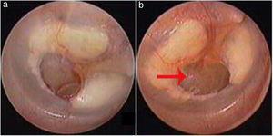 Cicatrização espontânea da perfuração traumática de membrana timpânica: 3 dias após a perfuração (a), cicatrização atrófica (b). As setas vermelhas indicam tímpano atrófico.