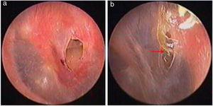 Cicatrização espontânea da perfuração traumática de membrana timpânica: 3 dias após a perfuração (a), cicatrização com crosta (b). As setas vermelhas indicam a crosta.