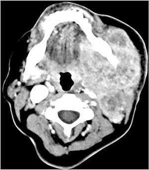 Tomografia computadorizada: tumor de glândula submandibular esquerda localmente avançado.