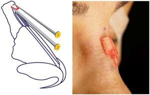 (1) Serra para radix nasal; (2) Osteótomo reto.