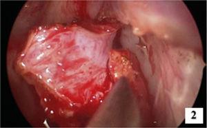 Imagem de ressecção com margens do septo posterior mostra mucosa dessa região saudável.