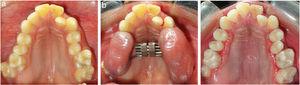 (a) Imagem oclusal maxilar pré‐tratamento mostra arco maxilar contraído em um paciente sem fissura; (b) montagem do aparelho de expansão rápida da maxila Hyrax em um paciente sem fissura; e (c) Após a conclusão do tratamento com ERM.