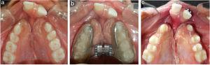 (a) Imagem oclusal maxilar pré‐tratamento mostra o colapso do arco superior em paciente com fissura labial bilateral, (b) montagem do aparelho de expansão rápida da maxila Hyrax no início da ERM no mesmo paciente e (c) imagem oclusal maxilar após a conclusão da ERM.