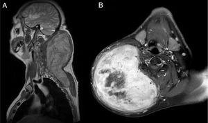 (A) Imagem coronal ponderada em T1 na ressonância magnética (RM), mostrando a presença de um tumor subcutânea medindo 13×14×22cm na área cervical posterior, que se estendia até a parede torácica posterior. (B) Imagem axial ponderada em T1 na RM mostrando realce significativo da lesão e destacando uma área necrótica central.