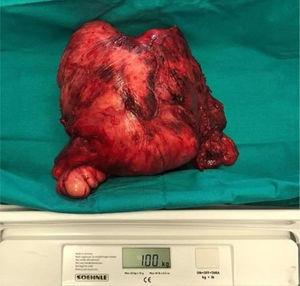 Aspecto macroscópico da lesão após excisão completa. O tumor media 20×22×25cm e pesava 1kg.