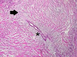 Imagem histológica mostrando células fusiformes com núcleos opacos (seta) e alteração mixóide focal (asterisco).