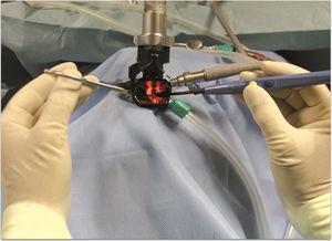 Laringoscópio bivalve no lugar. As mãos que seguram a pinça angulada (mão esquerda) e o microeletrodo angulado (mão direita) estão fora do campo. O microscópio cirúrgico é então usado.