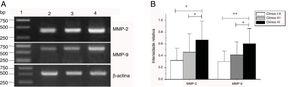Expressão de mRNA de MMP‐2 e MMP‐9 em tecidos tumorais de diferentes estágios clínicos obtidos de pacientes com carcinoma hipofaríngeo. (A) Expressão representativa de mRNA de MMP‐2 e MMP‐9 em tecidos tumorais de diferentes estágios clínicos. A expressão de MMP‐2 e MMP‐9 estava mais intensa nos estágios clínicos mais avançados (faixa 1, 1kb na escada de DNA; faixa 2, pacientes no Estágio I+II; faixa 3, pacientes no Estágio III; faixa 4, pacientes no estágio IV). (B) Intensidade relativa da expressão do mRNA de MMP‐2 e MMP‐9 em tecidos tumorais de diferentes estágios clínicos. Pacientes em estágio avançado exibiram níveis mais altos de expressão de mRNA de MMP‐2 e MMP‐9 do que pacientes em estágio inicial (*p <0,05 e ** p <0,01).