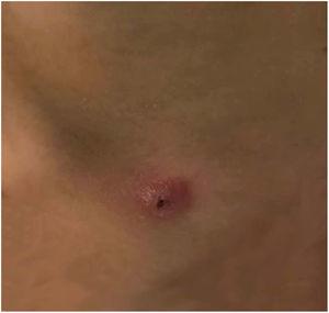 Abertura externa da fístula no lado esquerdo do pescoço, com congestão periférica da pele.