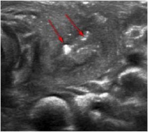 Exame ultrassonográfico: fortes ecos gasosos espalhados no abscesso tireoidiano esquerdo.