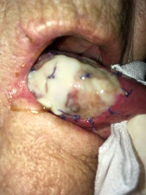Lado direito da língua aos 7 dias do pós‐operatório: a parte anterior do Tutopatch® começa a ser reabsorvida e substituída pela mucosa do próprio paciente.