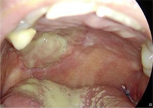O Tutopatch® cobre o defeito cirúrgico após a ressecção de um pT1 do palato duro do lado direito. A 15 dias do pós‐operatório, a própria mucosa do paciente está progressivamente substituindo o Tutopatch®.
