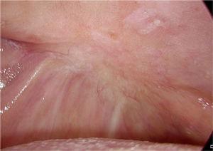 Palato duro no lado direito: 60 dias após a cirurgia, o defeito cirúrgico está completamente cicatrizado e coberto pela mucosa.