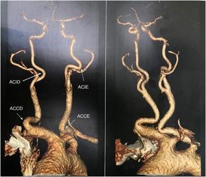 Reconstrução em 3D do arco aórtico e seus ramos, mostra as mesmas anormalidades. As setas indicam os locais de kinking em diferentes artérias.