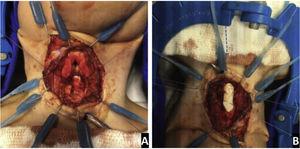 Uso de enxerto. Enxerto anterior e posterior da RLT fixado à cartilagem cricoide expandida (caso 7) (A) Enxerto posterior (B) Enxerto anterior.