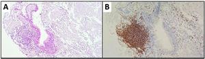Biópsia de laringe. (A) H&E. 10x: infiltrado linfoplasmocitário associado à mucosa de padrão respiratório, com formação de agregado linfoide e plasmocitose periférica; (B) CD20: agregado linfoide de células B.