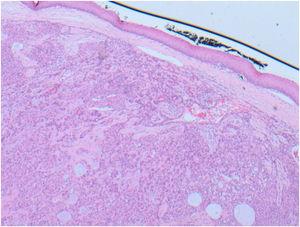 Histopatologia do nódulo excisado mostra componente predominantemente epitelial disposto em túbulos e áreas císticas com fundo mixomatoso e com epitélio escamoso do palato acima da lesão.
