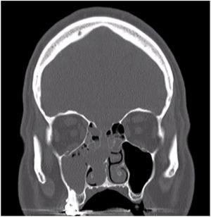 TC sem contraste. Corte coronal evidencia opacificação completa do seio maxilar direito, com opacificação parcial das células etmoidais e adelgaçamento da base do crânio.