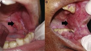 Retalho de masseter no (a) pós‐operatório de um mês e (b) pós‐operatório de um ano demonstra mucolização (seta).