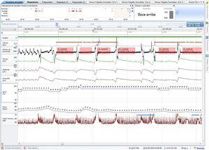Baseline polygraphy: EEG channels (top to bottom): position, activity, flow, chest band, abdominal band, sum of band readings, oxygen saturation, heart rate, and microphone. There is noise all through the events (microphone channel). Following each event there is an increase in activity signal.