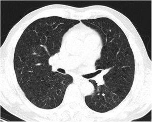 Disseminated Bacillus Calmette-Guérin (BCG) infection with pulmonary ...