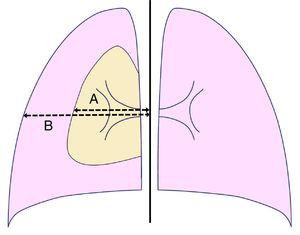 Light's index for estimating the size of pneumothorax. (A) Lung diameter and (B) hemithorax diameter (both measured at the level of pulmonary hilum).