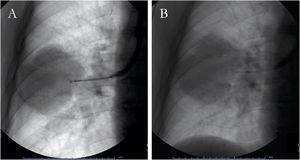Conventional fluoroscopy-guided transbronchial forceps biopsy (A) and needle aspiration (B) of a right pulmonary mass.