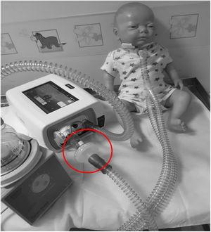 This picture shows the set-up of heated humidification if required in a child with a tracheostomy. Note the position of the filter on the expiratory limb to protect the ventilator and the environment.