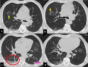 CT scan in supine (a,c) and prone (b,d) position. Some rounded areas of pure ground glass attenuation are present in the right upper lobe (a, upward yellow arrow), middle lobe and lingula. The GG attenuation in right upper lobe, in prone becomes crazy paving and is associated with occurring of an inside vessel enlargement (b, downward yellow arrow). In the right lower lobe a part-solid ground glass attenuation with a coexisting minimal crazy paving pattern, is present beneath the pleura (c; red ellipse) in the apical and postero- basal segments. Some vessel enlargement is present in both lower lobes. In the right lower lobe, the enlargement is both outside and inside the GG attenuation and involves branches of the pulmonary veins (caliber of 4.6 mm). Finally, in the left lower lobe, a nodular consolidation is present, adjacent to the pleura (pink arrow), with a drastic reduction in density with the prone positioning.