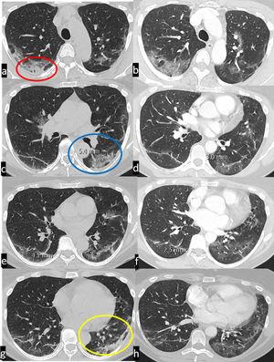 CT scan in supine (a, c, e, g) and prone (b, d, f, h) position. Bilateral peripheral ground glass attenuation, with solid component in the right postero-basal segment (red ellipse) and left postero-basal segment of the left lower lobe (yellow ellipse). The density of the attenuation decreases significantly with prone positioning. Vessel enlargement, consisting in venous dilatation, is present in both lower lobes, with a significant reduction in caliber with prone positioning (in the left lower lobe: 3 mm vs 5,4 mm).