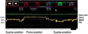 Pulse oximetry pleth waveform of the same patient during supine and prone position.