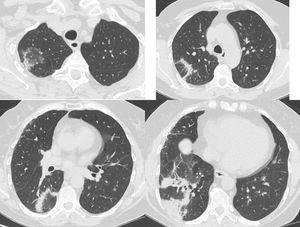 Same patient as Figure 1. Five months after treatment cessation. In the right upper and lower lobe there are areas consisting of an external rim of consolidation surrounding a central area of ground glass attenuation (reverse halo sign).