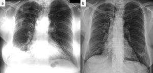 Same patient as Figure 1. Chest roentgenogram 5 months after cessation of steroids with areas of consolidation in the right upper and lower lung zone (panel a). After two months of treatment with azithromycin (250mg thrice weekly), there is a complete resolution of abnormal findings (panel b).