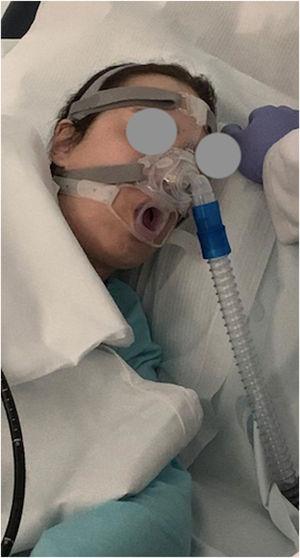 Mouthpiece placement for transoesophageal echocardiography probe insertion during non-invasive ventilation trough nasal mask.