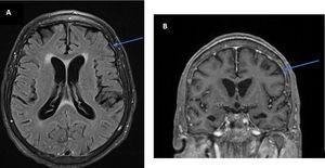 Brain MRI. A Axial FLAIR with gadolinium; B Coronal T1 with gadolinium – both show meningeal enhancement.