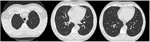 CT scan, four months after the onset of disease, showing complete resolution of the lung opacities.