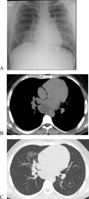 (Original images) (A) Chest x-ray with right mediastinal enlargement. (B-C) Chest computed tomography, depicting an infracarinal mediastinal mass and a right middle lobe consolidation. (Original images).