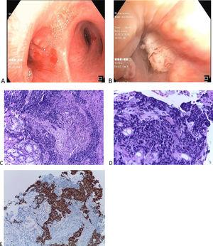 (Original images) (A-B) Videobronchofibroscopy images: (A) Small nodular lesions on the left main bronchus entrance (B) Middle lobe bronchus narrowing due to a “cauliflower” lesion. (C) Respiratory mucosa fragments, documenting infiltration by solid to trabecular pattern neoplasia of small, cuboidal cells with granular chromatin and generally absent nucleoli, with scant eosinophilic cytoplasm. Foci of necrosis and abrupt keratinization and keratin pearls formation are identified (C-HE 10x, D-HE 20x). (E) Immunohistochemical study positive, strong and diffuse for NUT (HE 10x). (Original images).