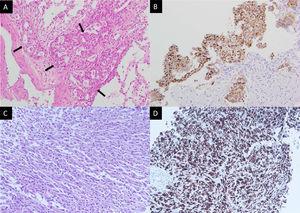 Pathology of the initial right upper lung tumor (A, B) and left pleural mass upon progression (C, D). (A) Hematoxylin and eosin stain showed round tumor cells (arrows) forming a glandular structure and solid nest. (B) Positive staining in ROS1 immunostaining. (C) Hematoxylin and eosin staining showed pleomorphic spindle-shaped tumor cells. (D) Tumor cells show positive staining in ROS1 immunostaining.
