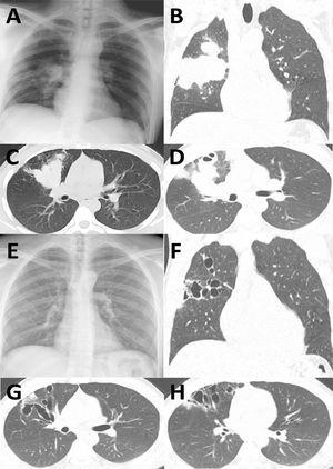 Comparison of chest X-ray and CT at admission (A-D, a 6 cm-long right hilar mass is observed, extending to the pleura and enlarged hilar lymph nodes) and 4 months after disease resolution (E-H, large varicoid bronchiectasis in both lungs can be observed, particularly in the right upper lobe.).