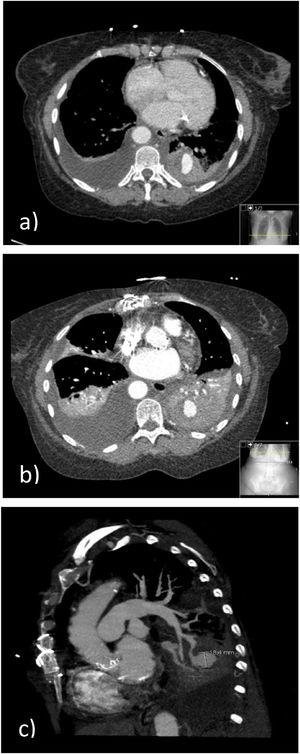 (A) Chest CT-angiography at ICU admission. consolidation at the left inferior lobe (LIL) with areas of spontaneous hyperdensity and "ground glass" opacities; Nodular lesion with contrast enhancement, at the posterior segment of the LIL, in continuity with a pulmonary artery tree branch, suggestive of a pseudoaneurysm with a mural thrombus. (B) and (C) Chest CT-angiography (7th day of hospitalization). Pseudoaneurysm arising from the posterior basal branch of the left inferior lobar pulmonary artery; bilateral pleural effusion with passive atelectasis; and consolidation due to hemorrhagic alveolar filling at the LIL.
