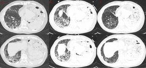CT axial slices during the evolution of the case. (A first column) CT after treatment for CMV and intravenous immunoglobulin demonstrating new ground glass opacities along with consolidations and reticular opacities. (B middle column) Despite treatment for both CMV and PCP, CT image reveals worsening in pulmonary compromise. (C third column) CT demonstrating significant radiological improvement after CPT followed by substantial clinical improvement in a short period of time.
