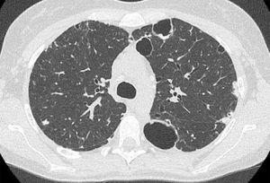 CT scan findings. Cysts with thickened walls in subpleural regions (the biggest are in the left lung); subpleural bilateral focal consolidation centrally cavitated. Centrilobular nodules are present in the anterior segment of the right upper lobe as well. Transbronchial lung cryo biopsies documented Pneumocystis jirovecii infection.